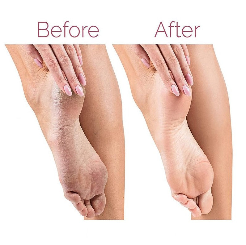 Electric Pedicure Foot File Callus Remover