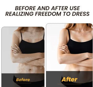 Sumifun - Vitamine Vitiligo Cream